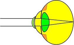 Grafische Darstellung eines zu kurzen Augapfels mit korrigierender Kontaktlinse