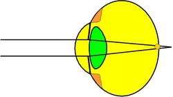 Grafische Darstellung eines zu kurzen Augapfels