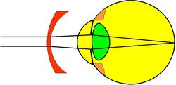 Grafische Darstellung eines zu langen Augapfels sowie einer korrigierenden Brille