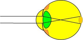 Darstellung eines Auges mit Myopie